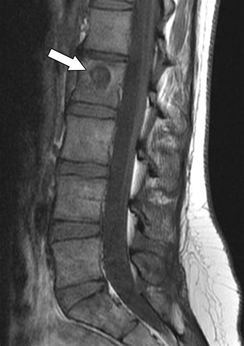 Lesions On Mri T Spine