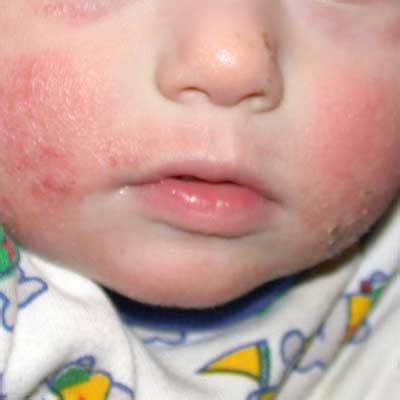 Pictures of Skin Allergies in Children