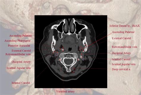 r@diOlogY dE aruN: Carotid Angio CT Vascular Anatomy