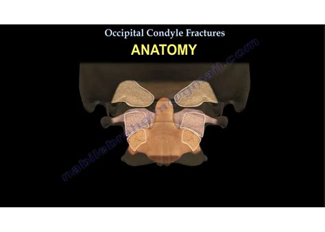 Occipital Condyle Fractures — OrthopaedicPrinciples.com