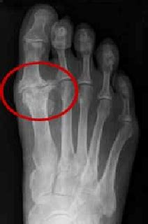 Arthritis of the Great Toe (Hallux Rigidus) | Murdoch Orthopaedic Clinic