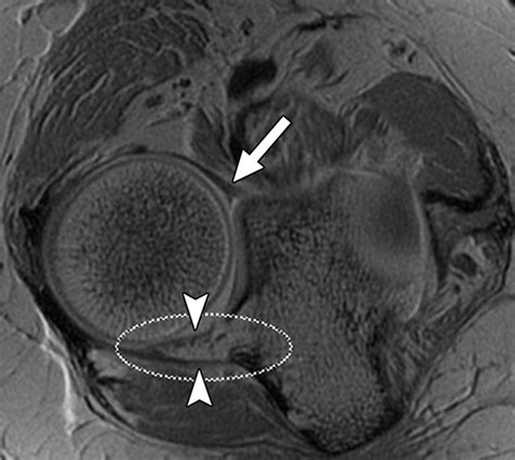 Annular Ligament of the Elbow: MR Arthrography Appearance With Anatomic and Histologic ...