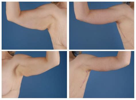 Arm lift recovery During your recovery from arm lift surgery, dressings ...