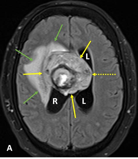 Intraventricular Hemorrhage (IVH) - Diagnosis - MRI Online