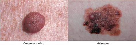 Identifying Mole vs. Melanoma: Critical Differences That Could Save ...