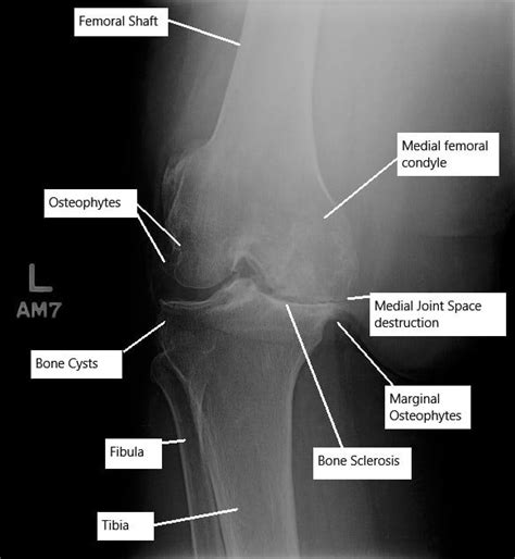 Xray Knee Osteoarthritis