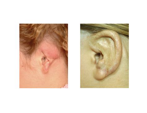 rib graft ear reconstruction Archives