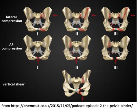 emDOCs.net – Emergency Medicine EducationEM@3AM: Pelvic Ring Fracture ...