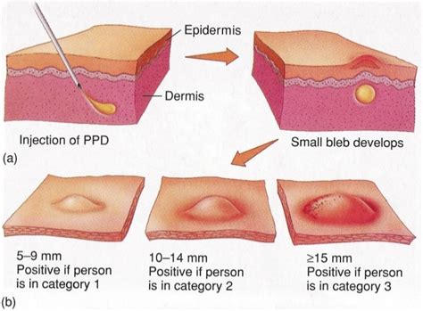 Positive TB Skin Test | New Health Advisor