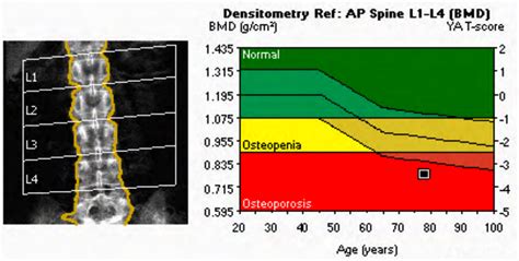 Osteoporosis & Bone Density - Boca Radiology Group