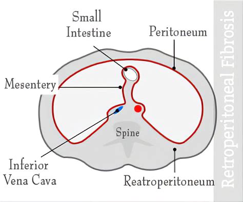 Retroperitoneal Fibrosis Ormond39s Disease Causes