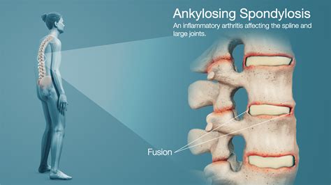 Top 186 + Inflammation medical animation - Lestwinsonline.com