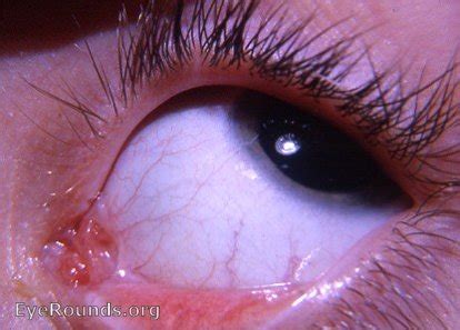 congenital anomaly of caruncula lacrimalis. EyeRounds.org: Online ...