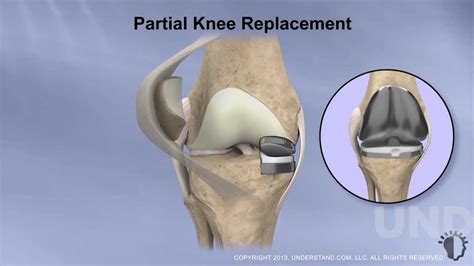 Partial Knee Replacement Procedure