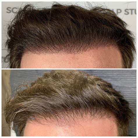 Scalp Studio - Scalp Micropigmentation - San Diego, California