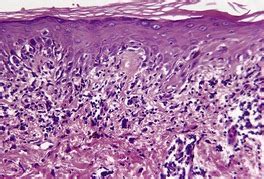 The lichenoid reaction pattern (‘interface dermatitis’) | Plastic Surgery Key