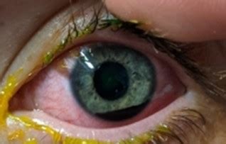 Blunt Eye Trauma: Complications, Symptoms, Causes, Diagnosis & Treatment