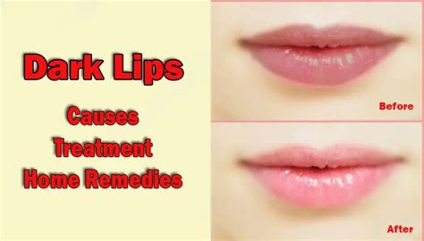 Dark lips or Black lips : Causes, Treatment and Home remedies - Info See Media