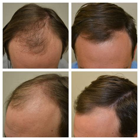 Minoxidil Before and After Photos [2024] | Is it right for you?