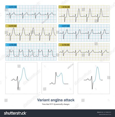 2 Angina Pectoris Stable Unstable Images, Stock Photos, 3D objects, & Vectors | Shutterstock