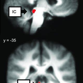 The left inferior colliculus (IC) was significantly activated by the... | Download Scientific ...