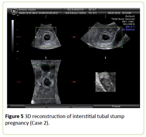 Sextuplets Ultrasound