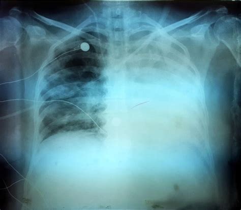 Difference Between Barotrauma and Volutrauma – Difference Between