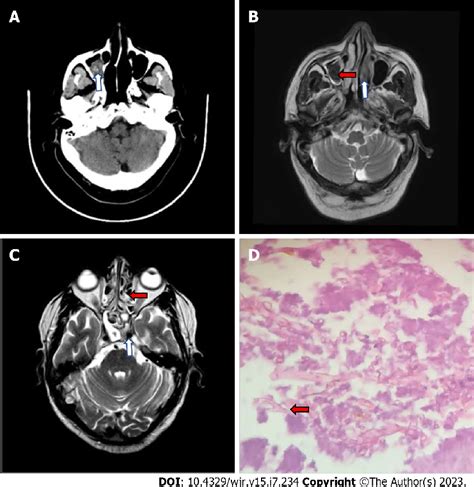 Figure 1 from Invasive rhinocerebral mucormycosis: Imaging the temporal ...