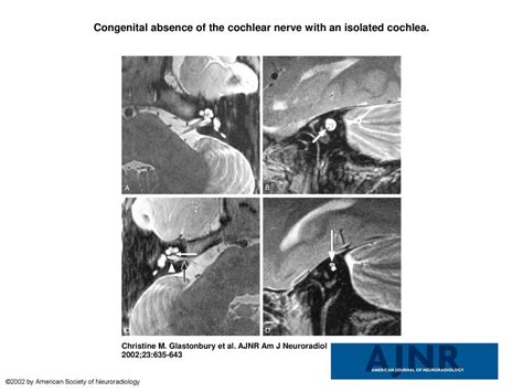 Congenital absence of the cochlear nerve with an isolated cochlea ...