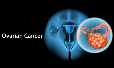 Advances In Ovarian Cancer Treatment Can Save Indian Women