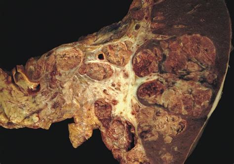 Pathology Outlines - Acinar cell carcinoma