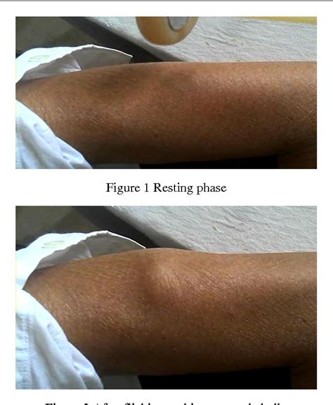 Figure 1 from Myoedema : A Presenting Symptom of Hypothyroid Myopathy | Semantic Scholar