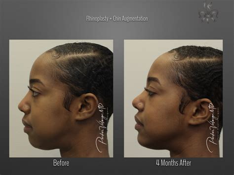 Chin Augmentation Case 4339 - New Orleans Premier Center for Aesthetics and Plastic Surgery