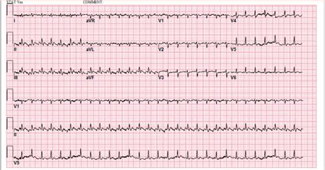 Cureus | Atrial Flutter as an Initial Presentation of Malignant ...