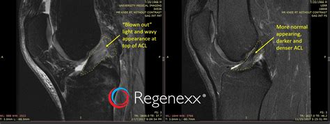 ACL surgery alternatives