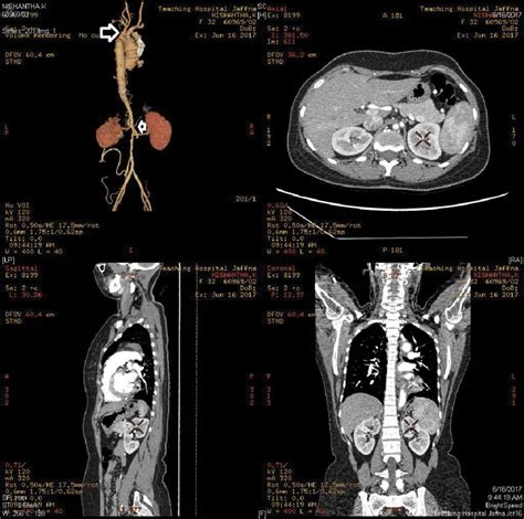 The CT aortogram and cerebral vessels angiogram of 32 years old lady... | Download Scientific ...