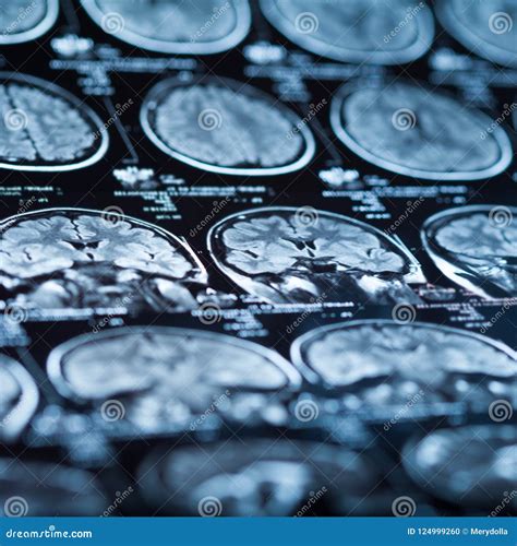 The X-ray of the Human Brain Stock Photo - Image of scan, disease: 124999260