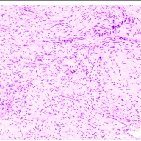 Histology showing appearance of sarcoma: tumour cells arranged in ...