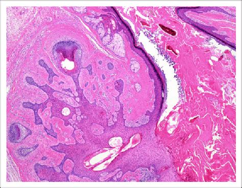 Histopathological image shows several small follicles varying in ...