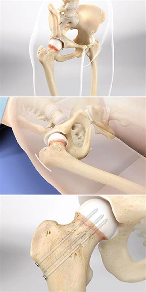 Femur Fracture Anatomy