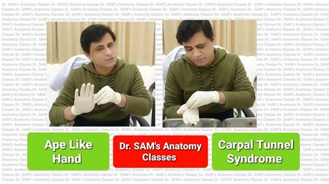 Carpal Tunnel Syndrome Anatomy | Ape Like Hand Deformity | CTS ...