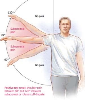 Shoulder Impingement Information Sheet - Australian Physiotherapy Equipment