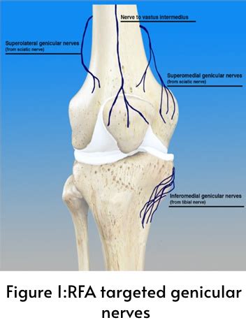 Genicular nerve Radio frequency ablation -A novel approach for chronic ...