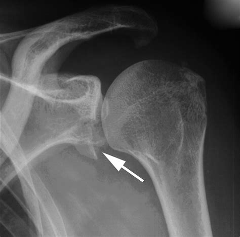 Non-operative treatment of large anterior glenoid rim fractures after traumatic anterior ...