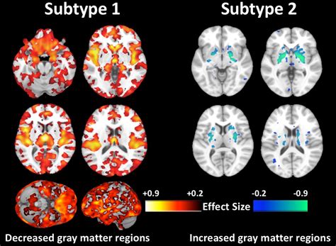 Two schizophrenia types discovered - Cosmos Magazine