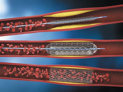 The story on heart stents - Harvard Health