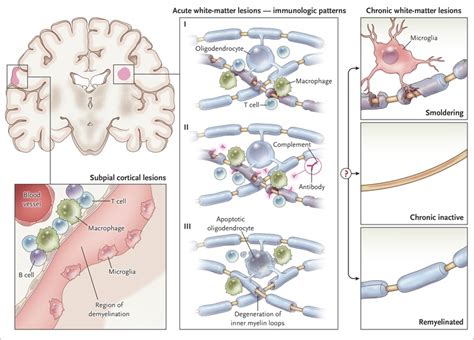 The central vein sign in MS – Multiple Sclerosis Research Blog