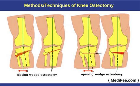 High Tibial Osteotomy - BSM Foundation