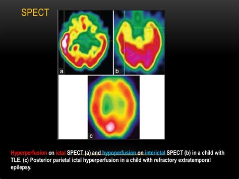 Mesial temporal lobe epilepsy