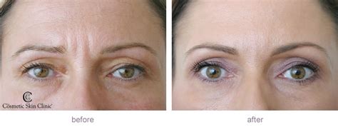 Dermal fillers : Before and after gallery